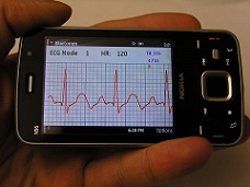 Cellphone ECG Monitor